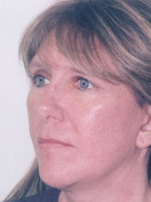 Female Facelift Patient 27 - After - 2