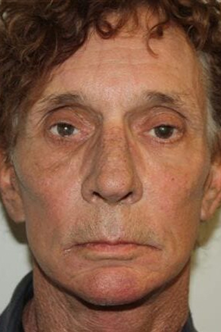 Male Facelift Patient 28 - After - 1