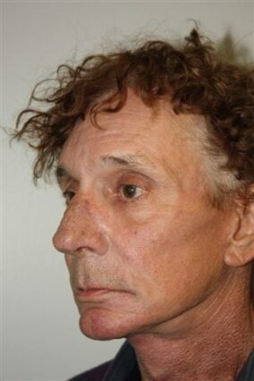 Male Facelift Patient 28 - After - 2