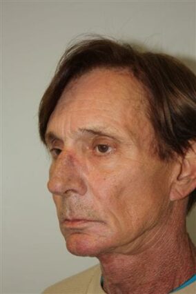 Male Facelift Patient 28 - Before - 2