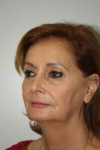 Female Facelift Patient 52 and Upper Lip Lift - Before - 1 Thumbnail