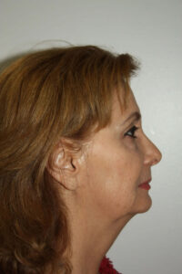 Female Facelift Patient 52 and Upper Lip Lift - Before - 3 Thumbnail