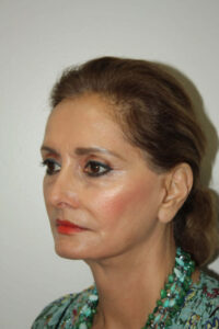 Female Facelift Patient 52 and Upper Lip Lift - After - 1 Thumbnail