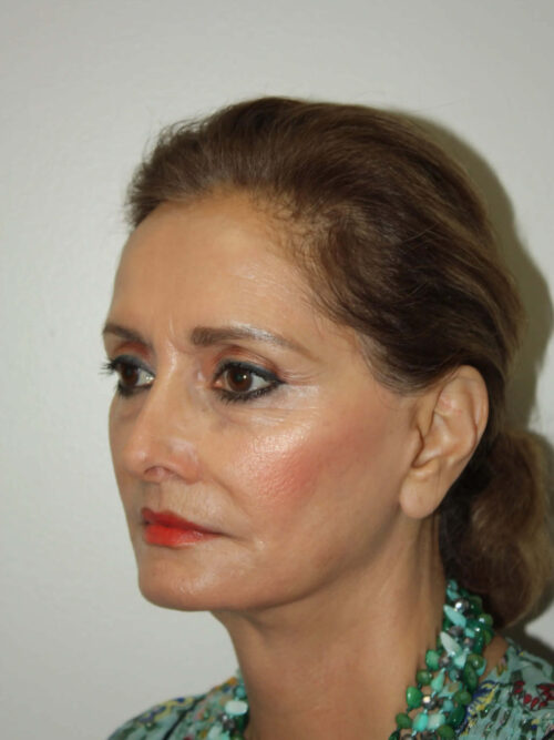 Female Facelift Patient 52 and Upper Lip Lift - After - 1