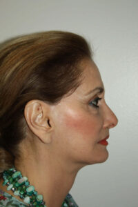 Female Facelift Patient 52 and Upper Lip Lift - After - 3 Thumbnail