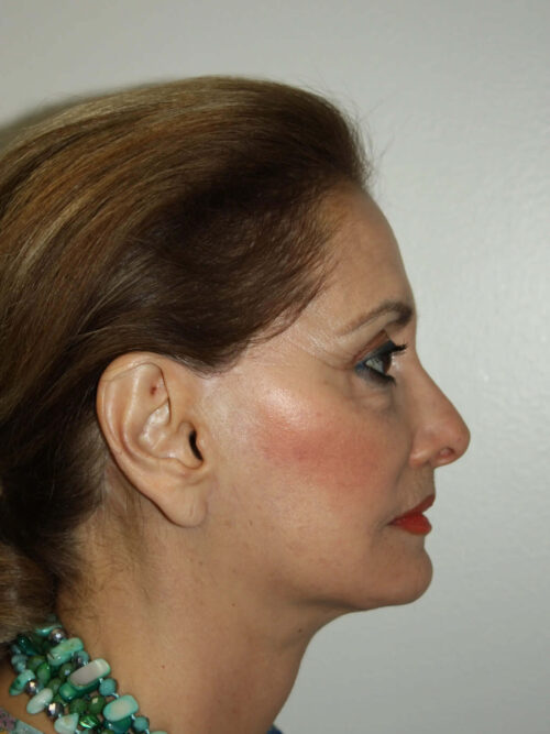 Female Facelift Patient 52 and Upper Lip Lift - After - 3