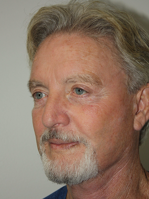 Male Facelift Patient 30 - After - 1