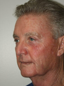 Male Facelift Patient 30 - Before - 1 Thumbnail