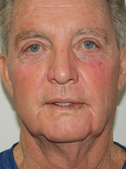 Male Facelift Patient 30 - Before - 2