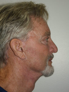 Male Facelift Patient 30 - After - 3 Thumbnail