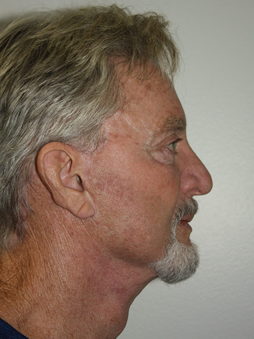 Male Facelift Patient 30 - After - 3