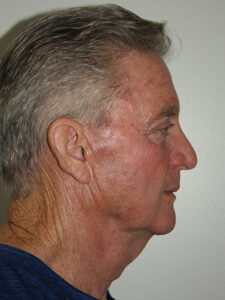 Male Facelift Patient 30 - Before - 3 Thumbnail