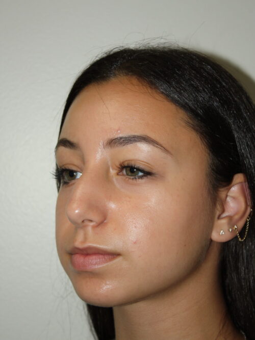 Rhinoplasty Patient 34 - Before - 2