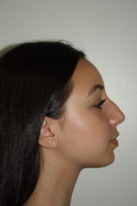 Rhinoplasty Patient 34 - Before - 1 Thumbnail