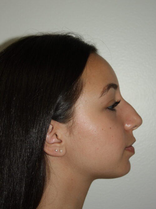 Rhinoplasty Patient 34 - Before - 1