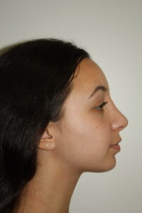 Rhinoplasty Patient 34 - After - 1 Thumbnail