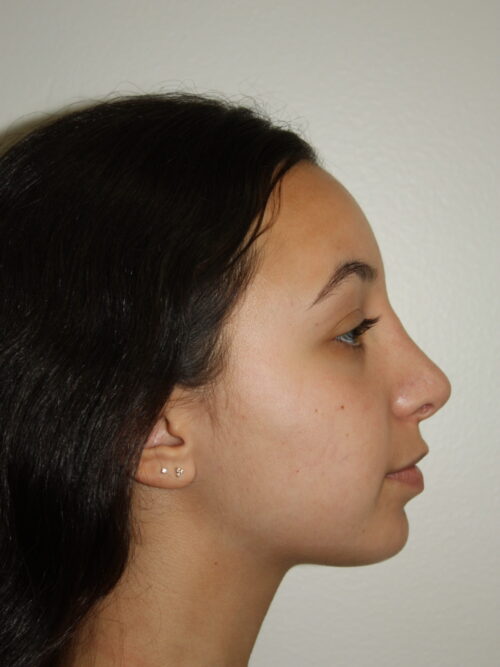 Rhinoplasty Patient 34 - After - 1