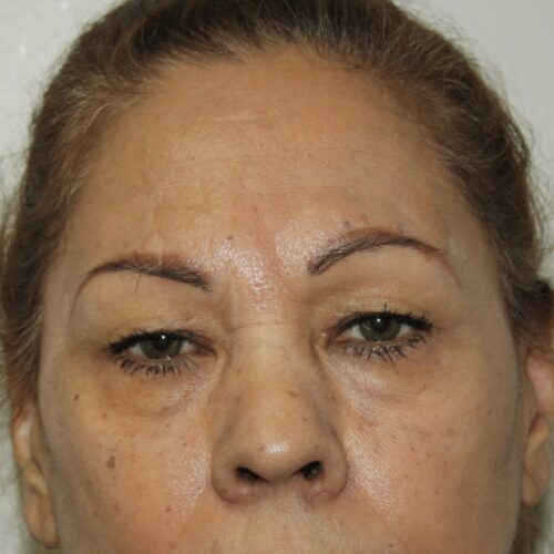 Eyelid Patient 25 - Before - 1