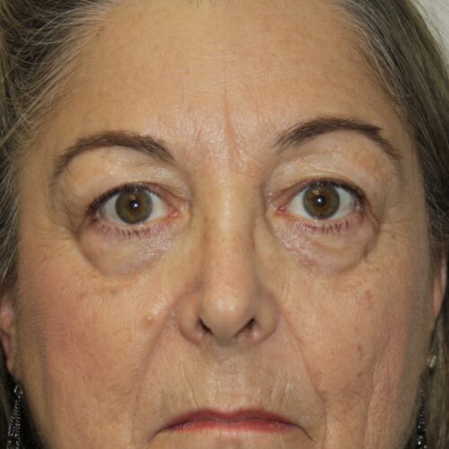 Eyelid Patient 26 - Before - 1