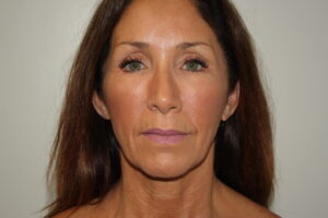 Female Facelift Patient 61 - Before - 2 Thumbnail