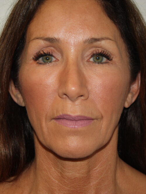 Female Facelift Patient 61 - Before - 2