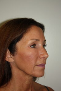 Female Facelift Patient 61 - Before - 1 Thumbnail