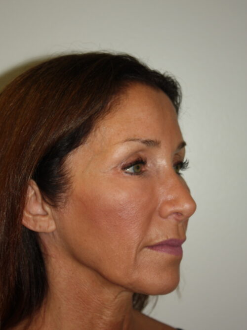 Female Facelift Patient 61 - Before - 1