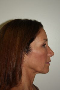 Female Facelift Patient 61 - Before - 3 Thumbnail