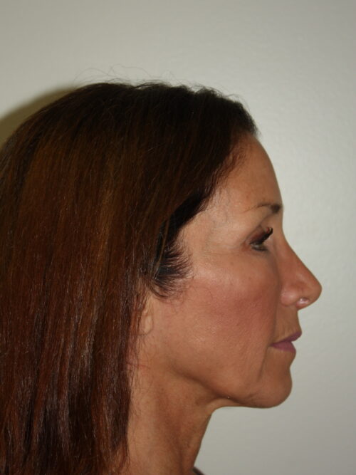 Female Facelift Patient 61 - Before - 3