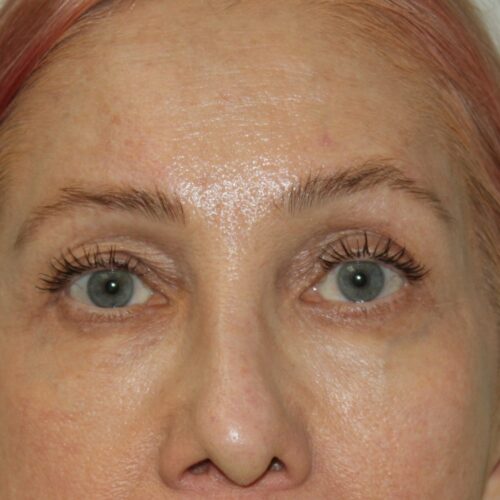 Eyelids Patient 28 - Before - 2