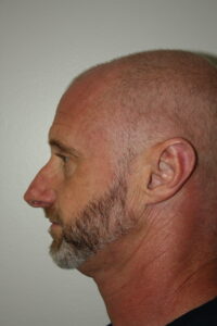 Male Rhinoplasty Patient 08 - Before - 1 Thumbnail