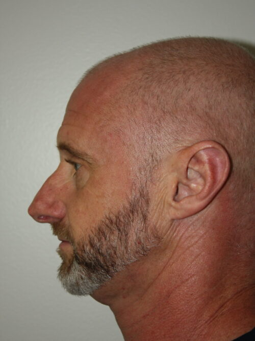 Male Rhinoplasty Patient 08 - Before - 1