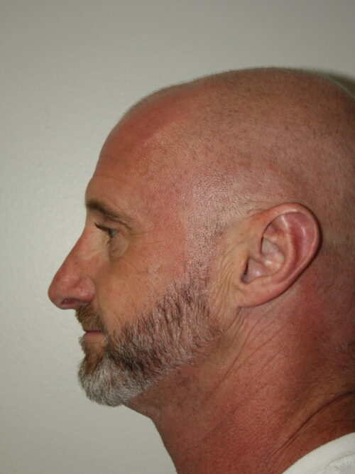 Male Rhinoplasty Patient 08 - After - 1