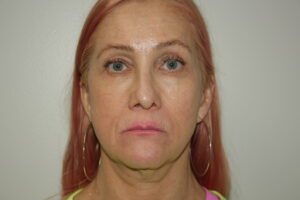 Female Facelift Patient 60 - Before - 2 Thumbnail