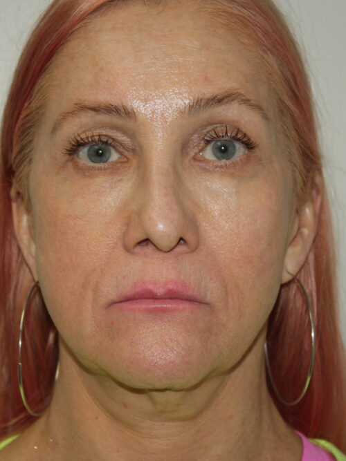 Female Facelift Patient 60 - Before - 2