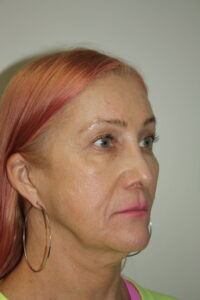 Female Facelift Patient 60 - Before - 1 Thumbnail