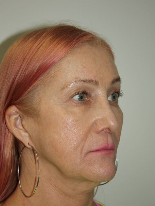 Female Facelift Patient 60 - Before - 1