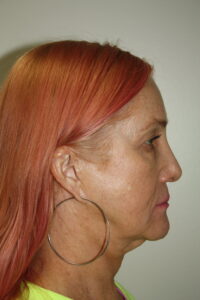 Female Facelift Patient 60 - Before - 3 Thumbnail