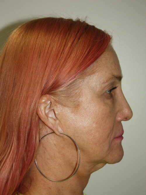 Female Facelift Patient 60 - Before - 3