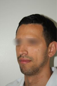 Male Rhinoplasty 07 and Chin Implant - Before - 2 Thumbnail