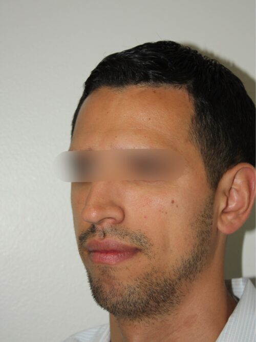 Male Rhinoplasty 07 and Chin Implant - Before - 2