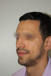 Male Rhinoplasty 07 and Chin Implant - After - 2 Thumbnail