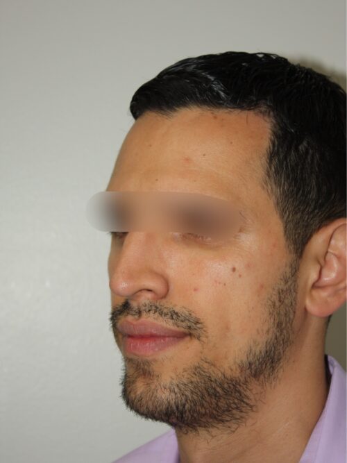 Male Rhinoplasty 07 and Chin Implant - After - 2