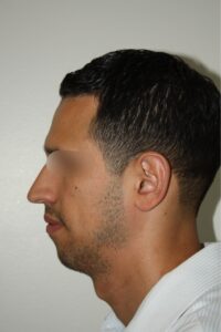 Male Rhinoplasty 07 and Chin Implant - Before - 1 Thumbnail