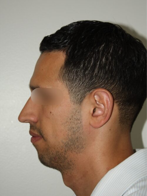 Male Rhinoplasty 07 and Chin Implant - Before - 1