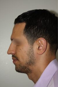 Male Rhinoplasty 07 and Chin Implant - After - 1 Thumbnail