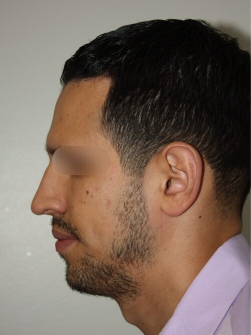 Male Rhinoplasty 07 and Chin Implant - After - 1