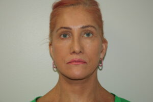 Female Facelift Patient 60 - After - 2 Thumbnail