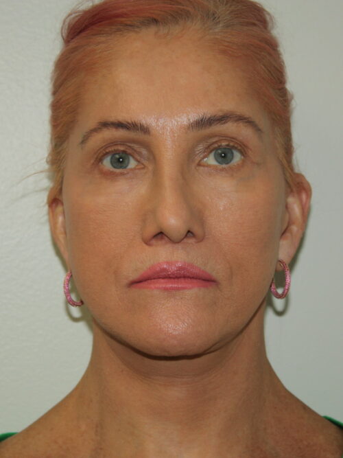 Female Facelift Patient 60 - After - 2