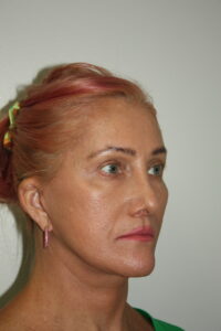 Female Facelift Patient 60 - After - 1 Thumbnail